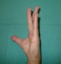 Inability to extend ring finger